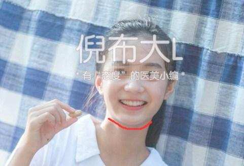 垫下巴是怎么回事，垫下巴的坏处（娱乐圈女星都选择了哪几种垫下巴方法）