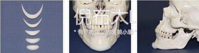 垫下巴是怎么回事，垫下巴的坏处（娱乐圈女星都选择了哪几种垫下巴方法）