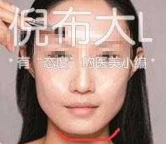 垫下巴是怎么回事，垫下巴的坏处（娱乐圈女星都选择了哪几种垫下巴方法）