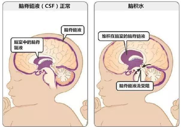 婴儿脑积水的原因，婴儿得脑积水的原因（小儿脑积水的常见致病原因和治疗方式）