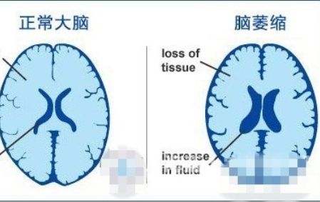 血肿变软了是怎么回事（血肿硬块变软需要多久）