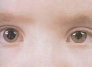 瞳孔缩小意味着什么，老人瞳孔缩小意味着什么（观察瞳孔，可以知病）