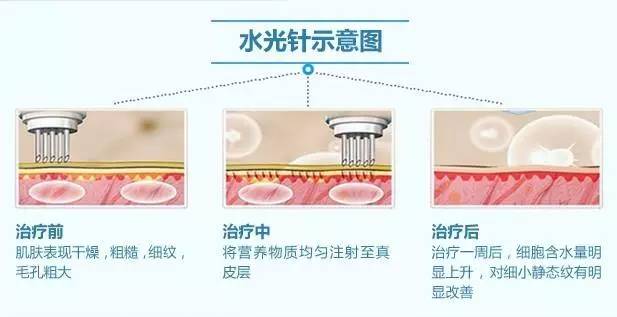 无针水光是什么，什么是无针水光（范冰冰35岁素颜白到发光）