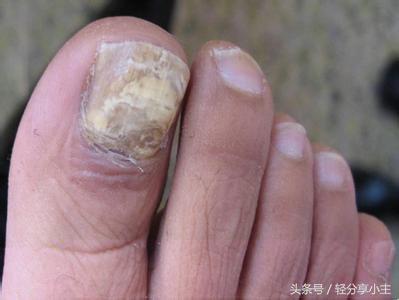轻微灰指甲的症状图片，灰指甲的症状图片（老中医“这种情况你得了假的灰指甲”）