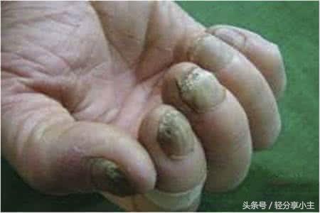 轻微灰指甲的症状图片，灰指甲的症状图片（老中医“这种情况你得了假的灰指甲”）