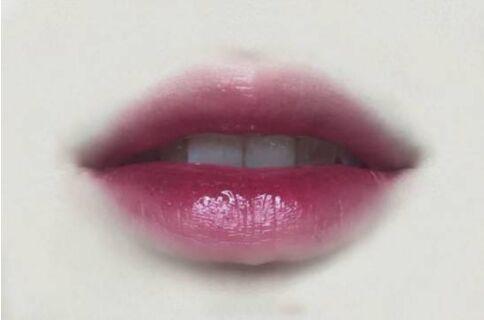 唇峰整形手术是将身体其它部位的脂肪抽吸经过活化处