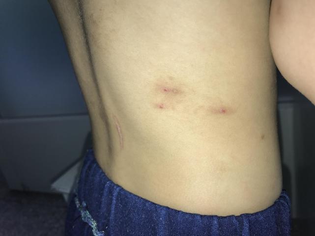 跳蚤长什么样子图片，虱子跳蚤图片（虱子跳蚤咬人的伤口）