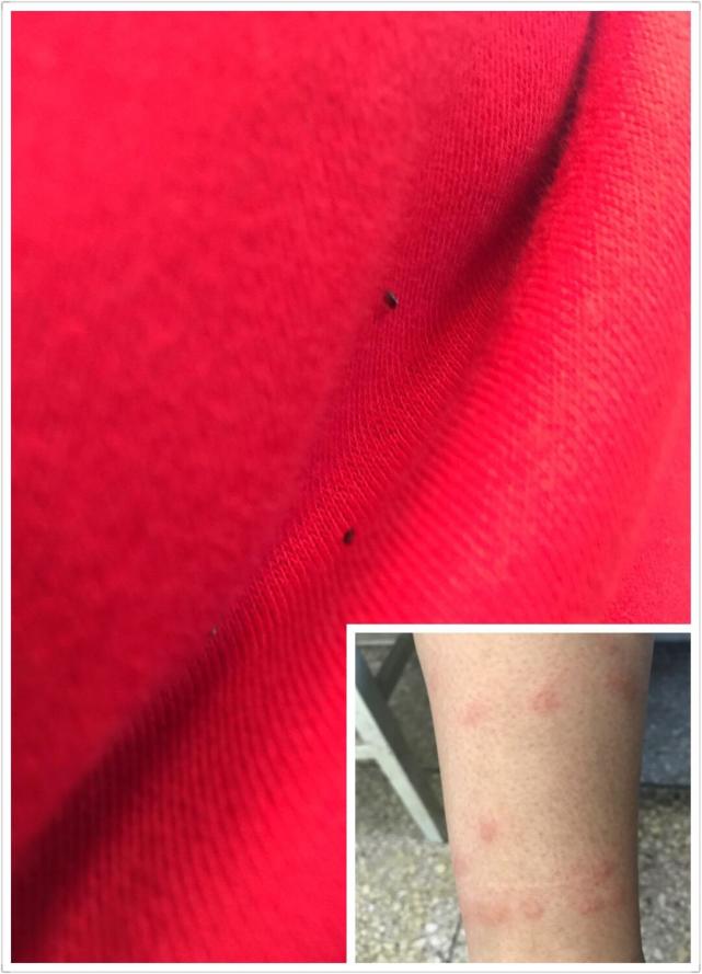 跳蚤长什么样子图片，虱子跳蚤图片（虱子跳蚤咬人的伤口）