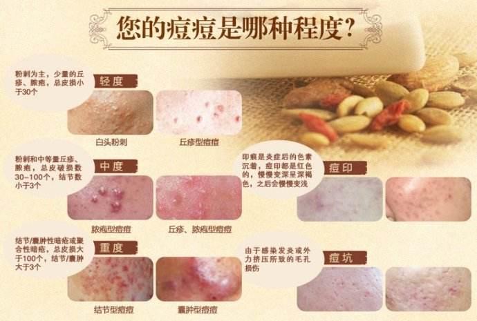 两腮长痘痘是什么原因，两腮长痘痘是什么原因引起的还痒（22种痘痘原因你中招了没有）