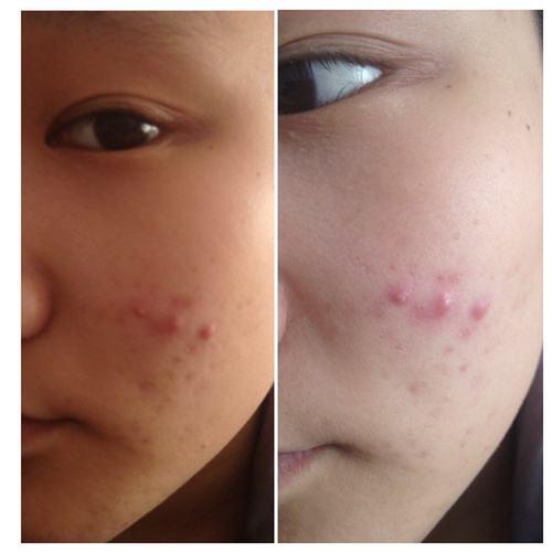 两腮长痘痘是什么原因，两腮长痘痘是什么原因引起的还痒（22种痘痘原因你中招了没有）