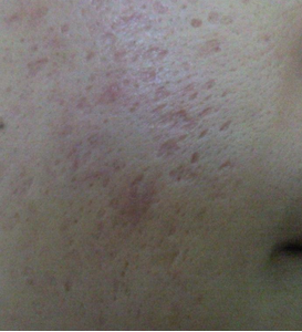 生姜可以去疤痕吗，去疤痕用生姜好还是土豆好（祛疤痕的小妙方）