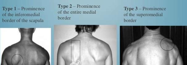 肩胛骨突出怎么矫正，肩胛骨突出（6个动作矫正肩背不良各种姿势）