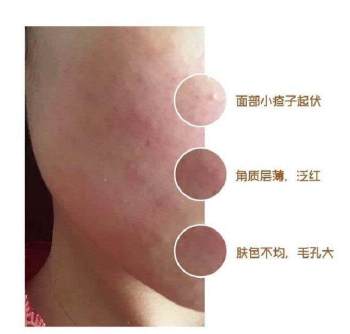 乐肤霜与肤乐霜区别，肤乐霜有几种（激素依赖性皮炎你知道多少）