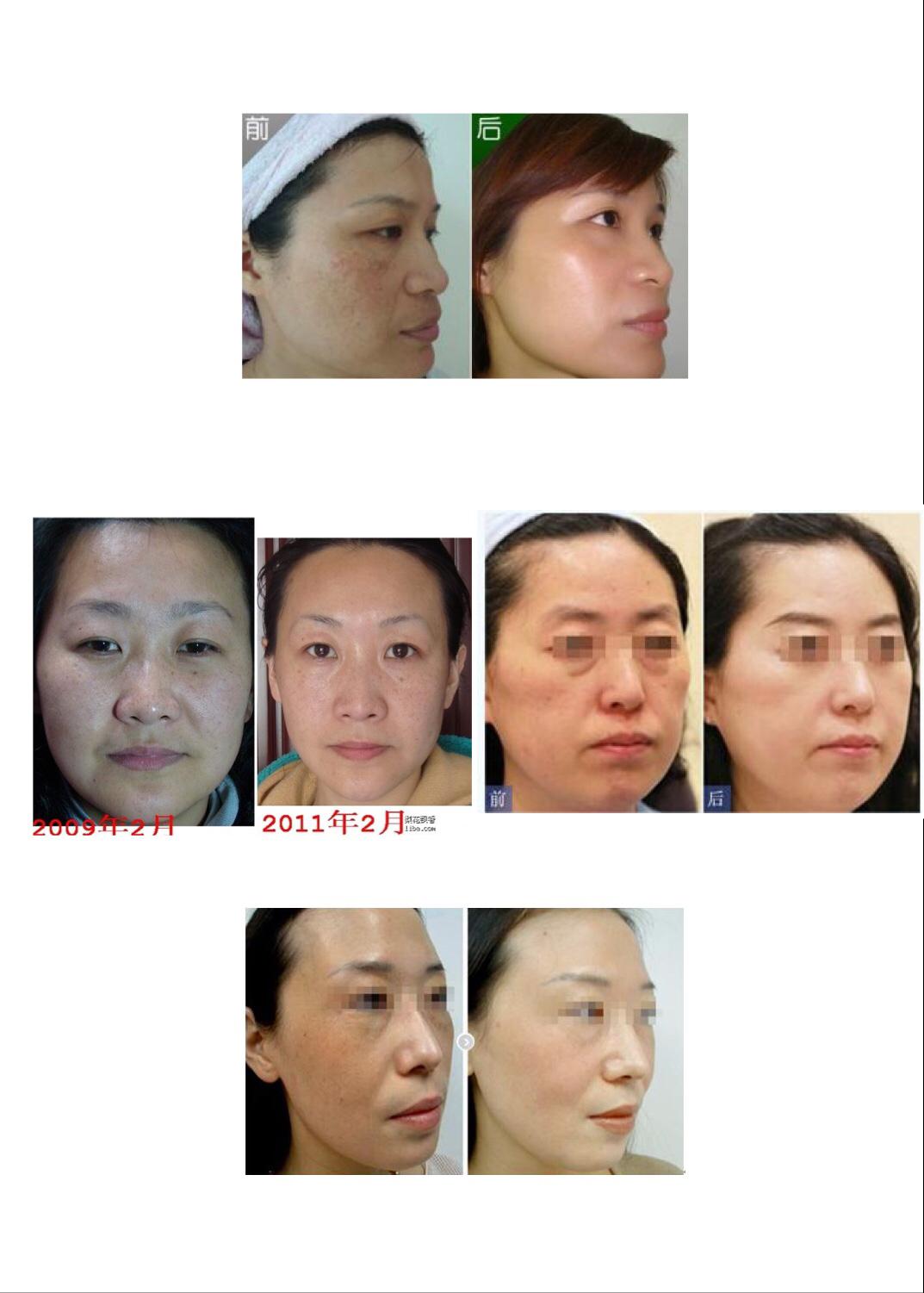 自制去雀斑面膜，自制祛斑面膜还你光洁无瑕肌（48岁阿姨自制祛斑面膜）