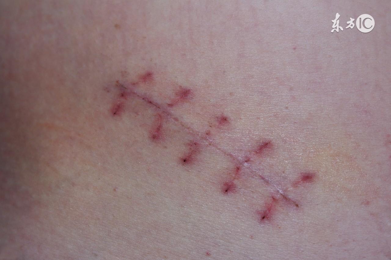 土方祛25年疤痕疙瘩，治胸前疤痕疙瘩的民间土方（三七粉加醋治疗疤痕）