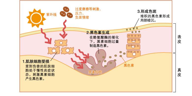我27岁生完小孩后开始长斑,刚开始每天带小孩忙得没时间顾自己,觉得斑