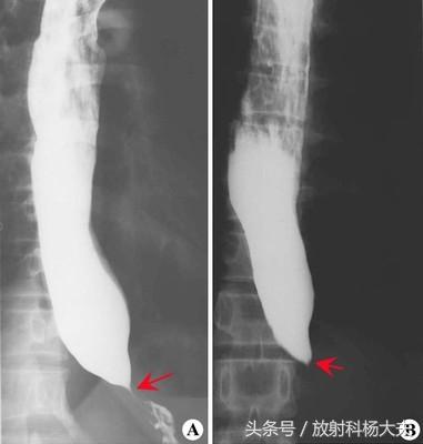 钡餐检查多少钱(钡餐和胃镜哪个准确度高)插图(1)