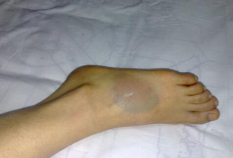 脚崴了肿了怎么消肿止疼,扭伤脚踝怎么消肿止痛(崴脚了怎么快速恢复)