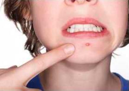 生活小妙招帮你解决顽固痘印，顽固痘印怎么消除（再顽固不化的痘印）