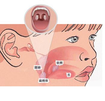 扁桃体发炎筷子点盐，扁桃体发炎 筷子点盐有用吗（扁桃体发炎怎么办）