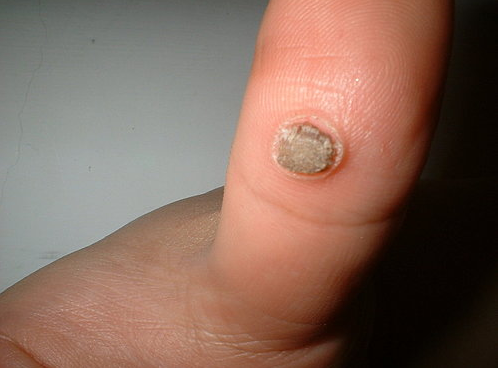 又叫做"鸡眼",专业上叫做"寻常疣"(是民间对丝状疣,跖疣,指状疣