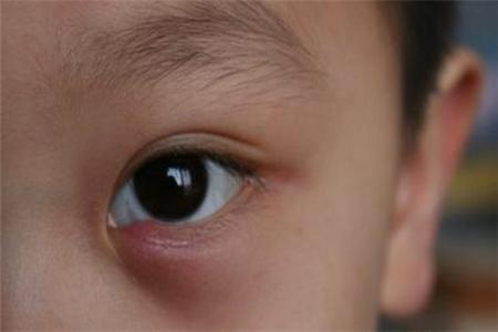 最近有一宝妈发现儿子眼皮上长了个包,眼皮出现红肿,疼痛难忍,儿子老