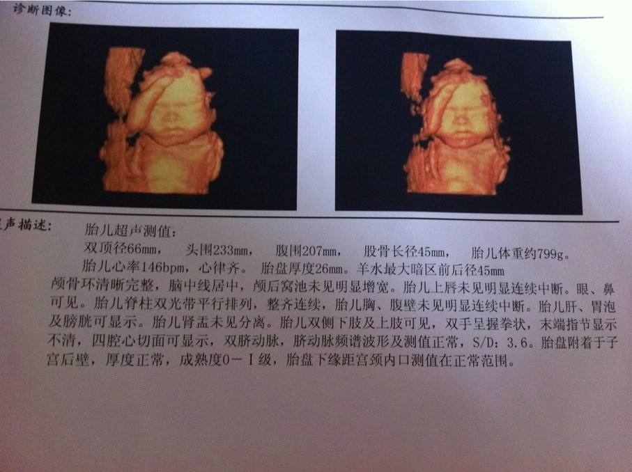 四维彩超,很多人都寄希望通过它辨别宝宝性别.