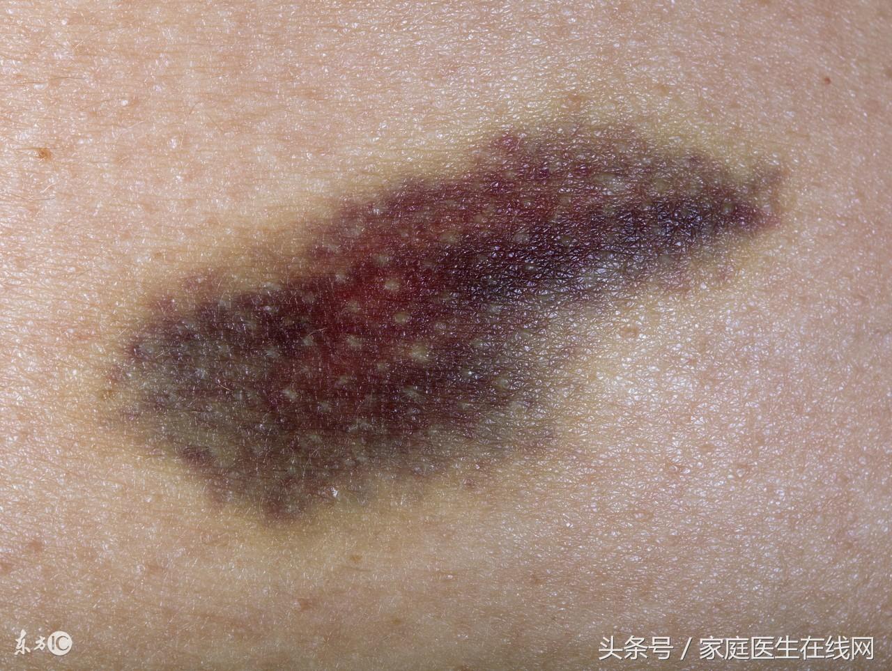 为什么磕碰后皮肤会出现淤青,皮肤碰了容易淤青(身上经常有莫名淤青?