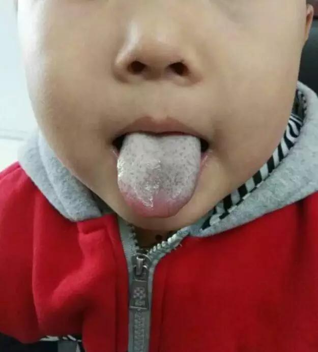 舌苔读音的拼音，舌苔读音（孩子又白又厚的舌苔没了）
