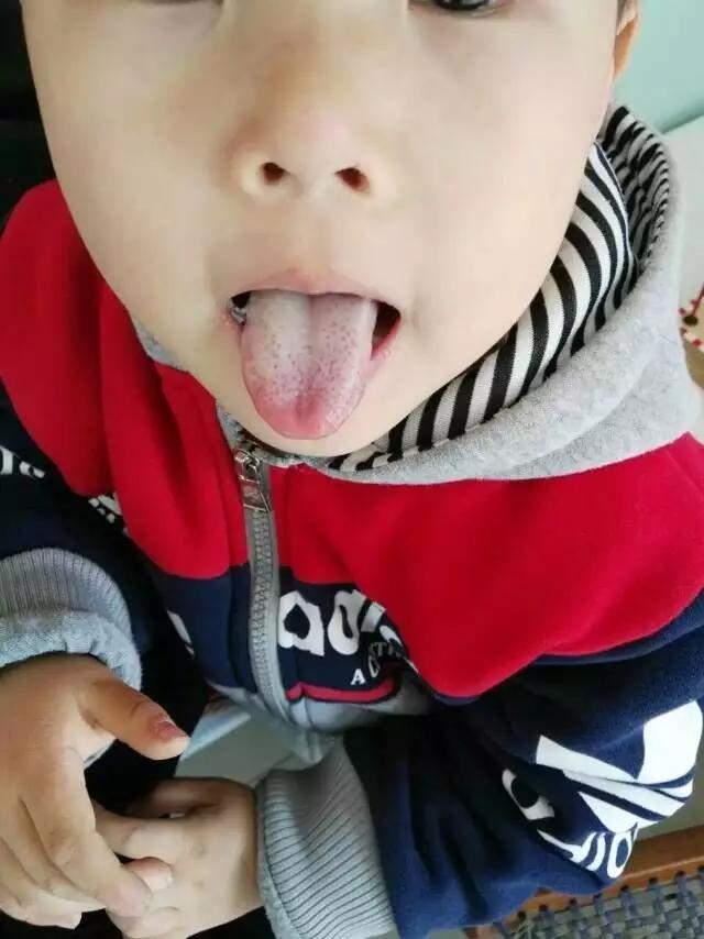 舌苔读音的拼音，舌苔读音（孩子又白又厚的舌苔没了）