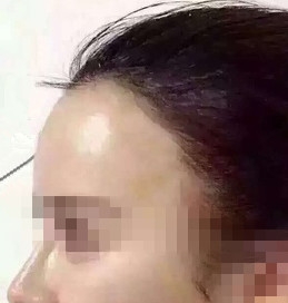 自体脂肪面部填充价格多少钱(自体脂肪填充价格一览表)