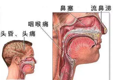 小孩鼻梁发黑怎么回事（儿童鼻梁黑线）