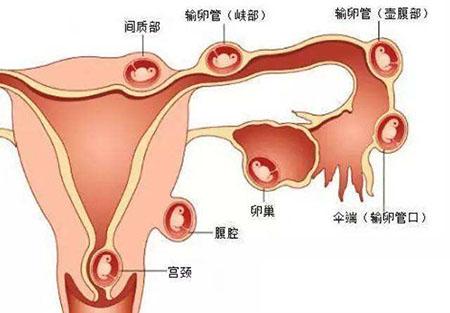 输卵管化脓严重吗，输卵管发脓严重的吗（什么习惯会导致宫外孕的风险增加）