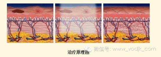 电波拉皮有什么用呢，电波拉皮有效果吗（你和牛奶肌之间只差一道光）