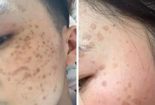 眼皮上长疣图片，眼皮上长脂肪粒（皮肤疣——你的皮肤还好吗）