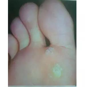 眼皮上长疣图片，眼皮上长脂肪粒（皮肤疣——你的皮肤还好吗）