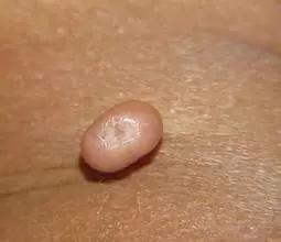 眼皮上长疣图片，眼皮上长脂肪粒（皮肤疣——你的皮肤还好吗）