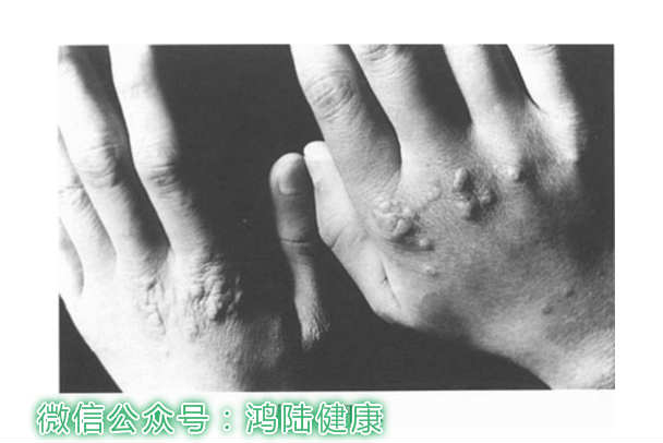 指甲上有黑点图片，指甲上有黑点是怎么回事（指甲盖旁长黑点，不要随意剪）