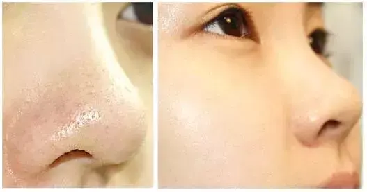 黑头怎么去除简单方法，男生脸上黑头怎么去除简单方法（两个中医“妙方”教你去除黑头无烦恼）