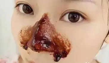 黑头怎么去除简单方法，男生脸上黑头怎么去除简单方法（两个中医“妙方”教你去除黑头无烦恼）