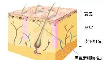 雀斑怎么生成的，脸上的雀斑怎么去除最有效药（人为啥会长雀斑）