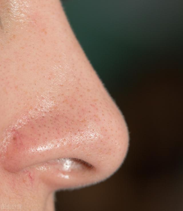 鼻子出油多是什么原因，如何改善鼻子出油（鼻子周围的分泌物是什么）