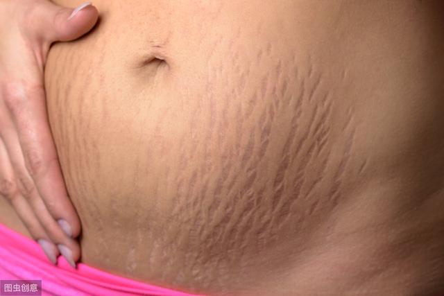 肥胖纹严重图片，肥胖纹怎么去掉怎么消除（肥胖纹和妊娠纹都可以通过减重消除吗）