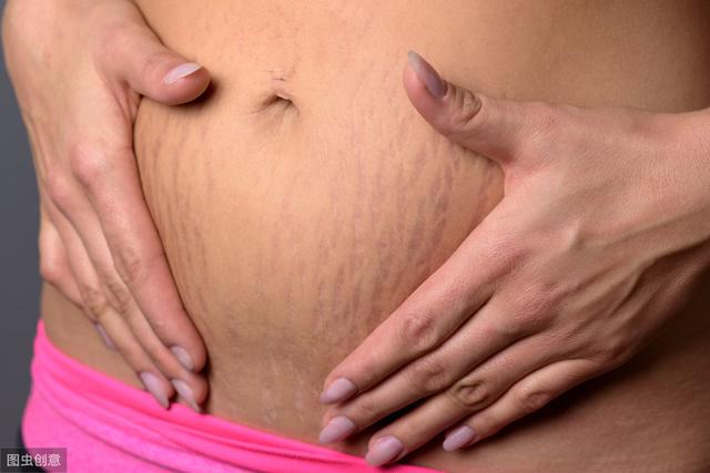 长妊娠纹怎么防止，孕妇肚子妊娠纹怎么预防（预防妊娠纹的关键是做好两点）
