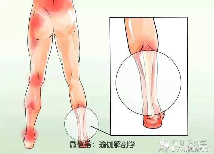 扁平足怎么治疗，扁平足如何治疗和恢复（如何治疗平足Ⅰ——了解平足的类型）