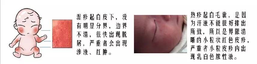 湿疹和热疹有什么区别，婴儿湿疹和热疹的区别（湿疹宝宝如何洗澡护肤、用药、打预防针）