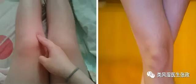 治疗风湿的仪器有哪些类风湿为什么会导致关节畸形残疾？→关 键在于反复发作的滑膜炎！_https://www.jmylbn.com_新闻资讯_第2张