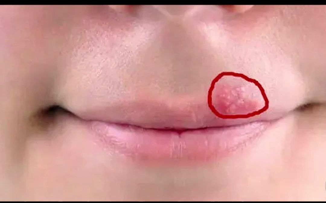 嘴巴周围有经验的时不时出水泡医生都会说:这是单纯疱疹发作