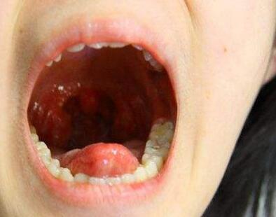 舌扁桃体发炎症状图片图片