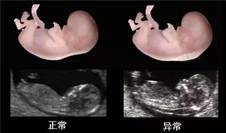 nt偏高怎么办